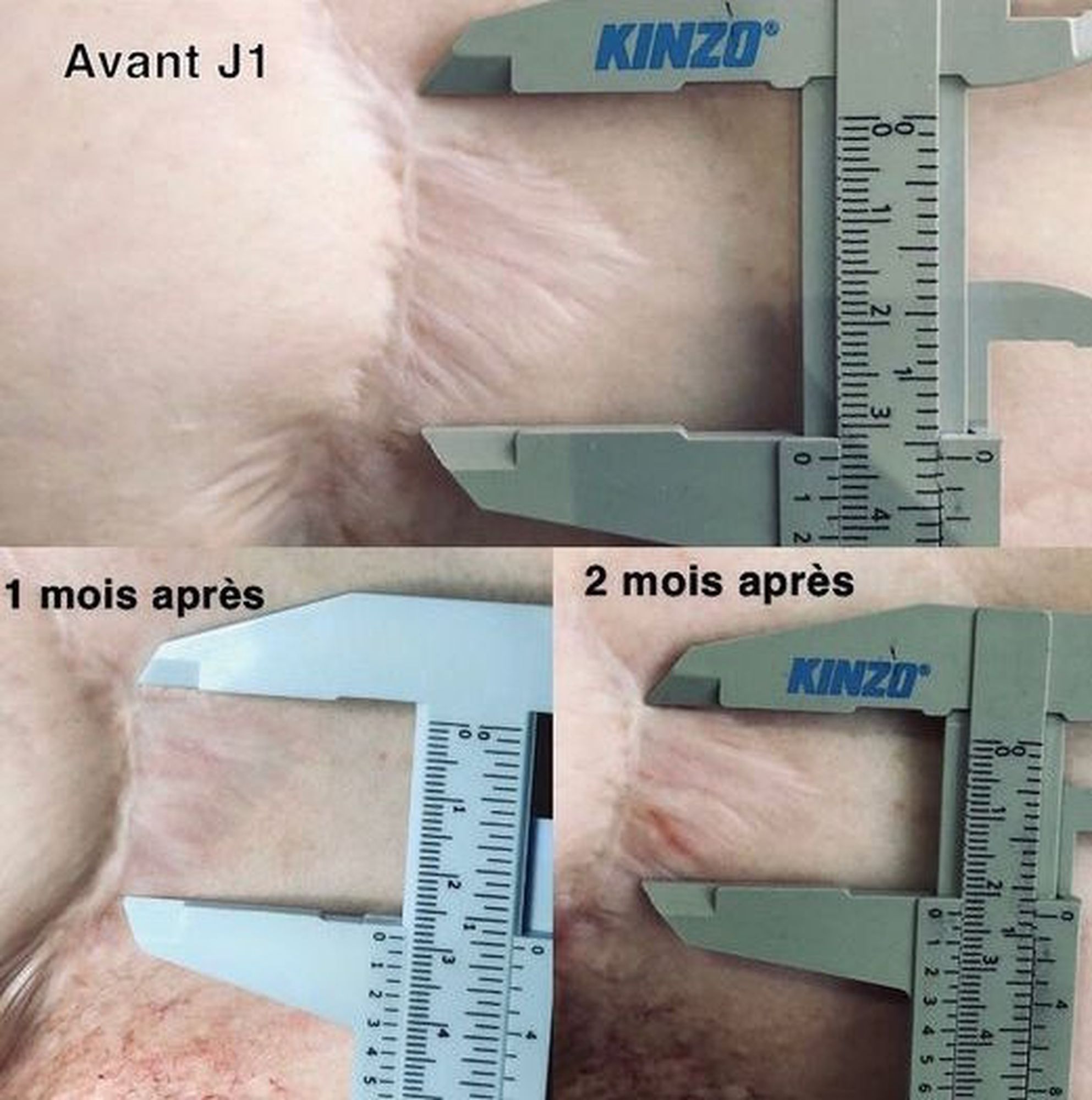 Exemple de résultat sur cicatrices chirurgicales